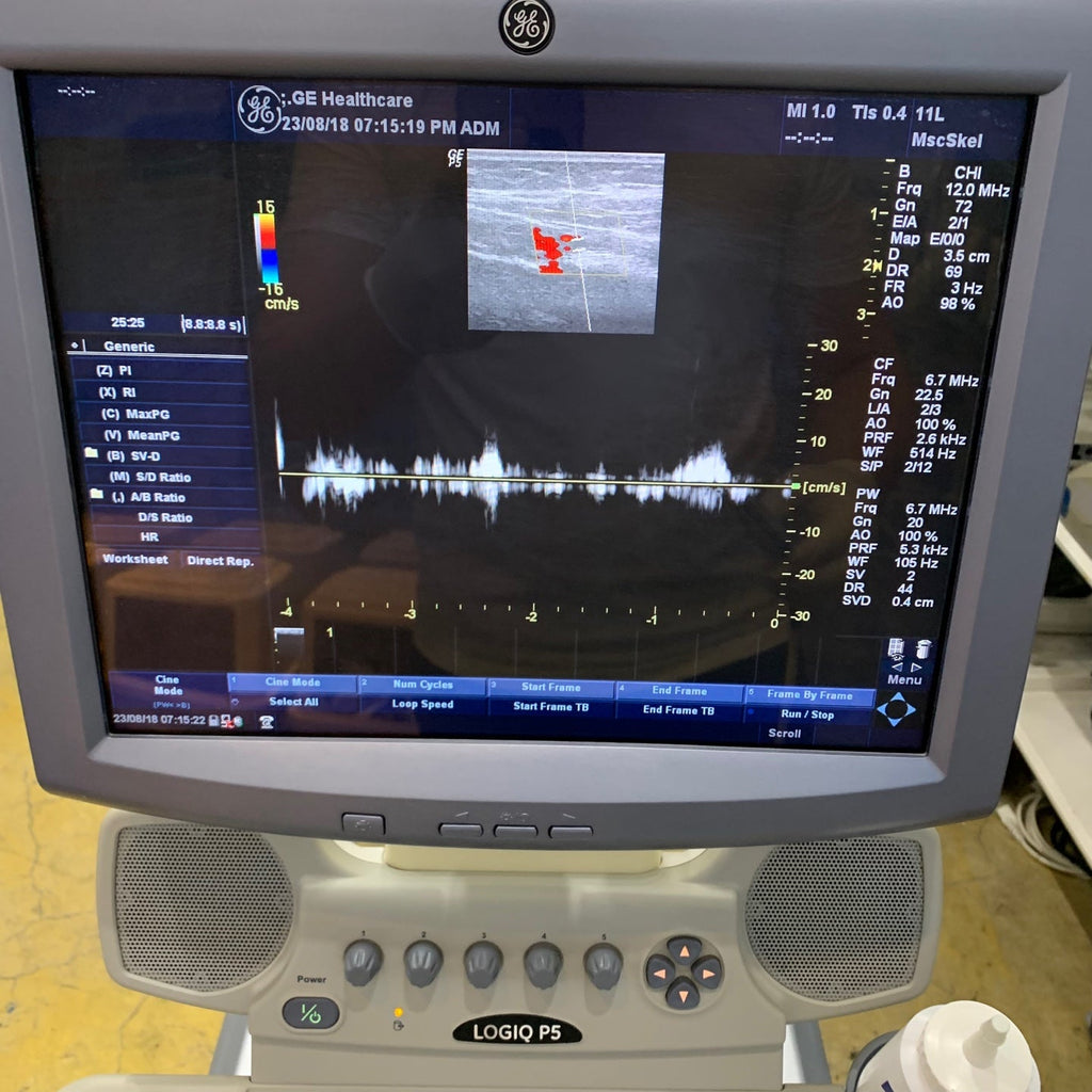 Used GE Logiq P5 Ultrasound Unit with Linear Probe Convex Probe