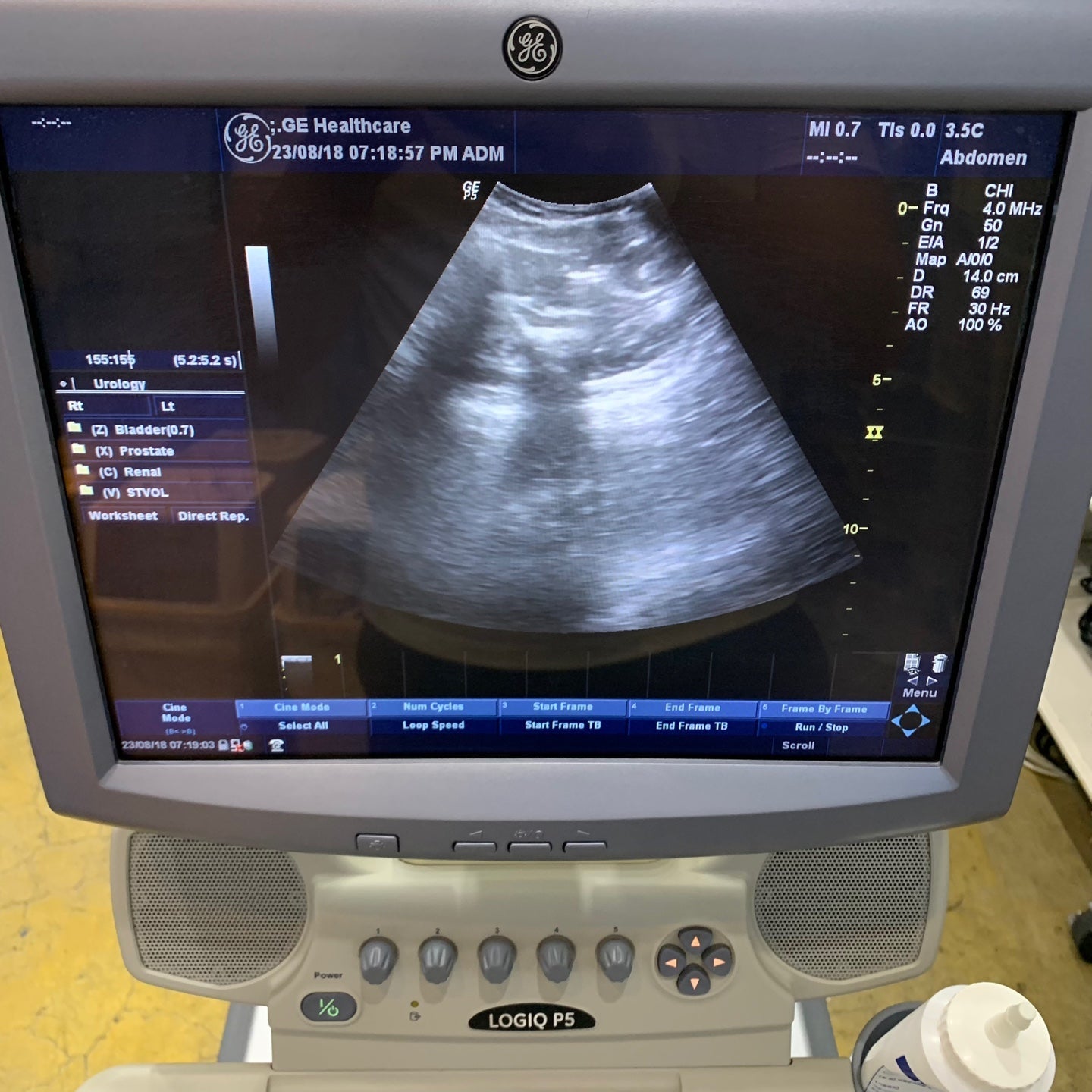 Used GE Logiq P5 Ultrasound Unit with Linear Probe Convex Probe