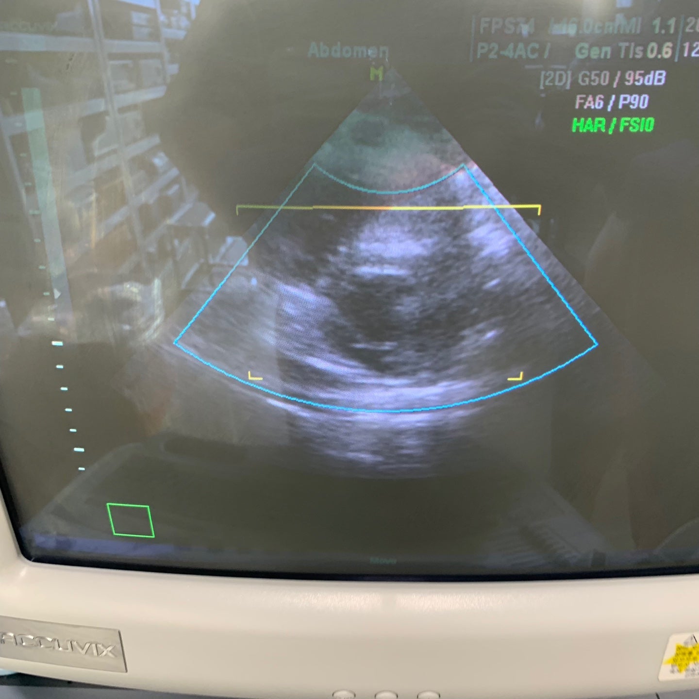 Used Medison Accuvix XQ 3D Ultrasound With 3Probes