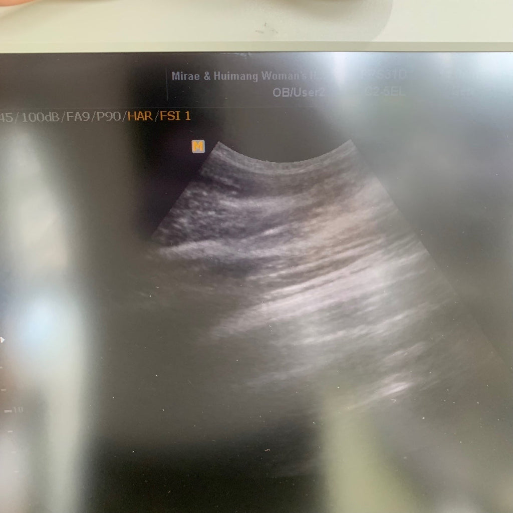 Used Medison Accuvix V10 Ultrasound with Convex Vaginal Probes