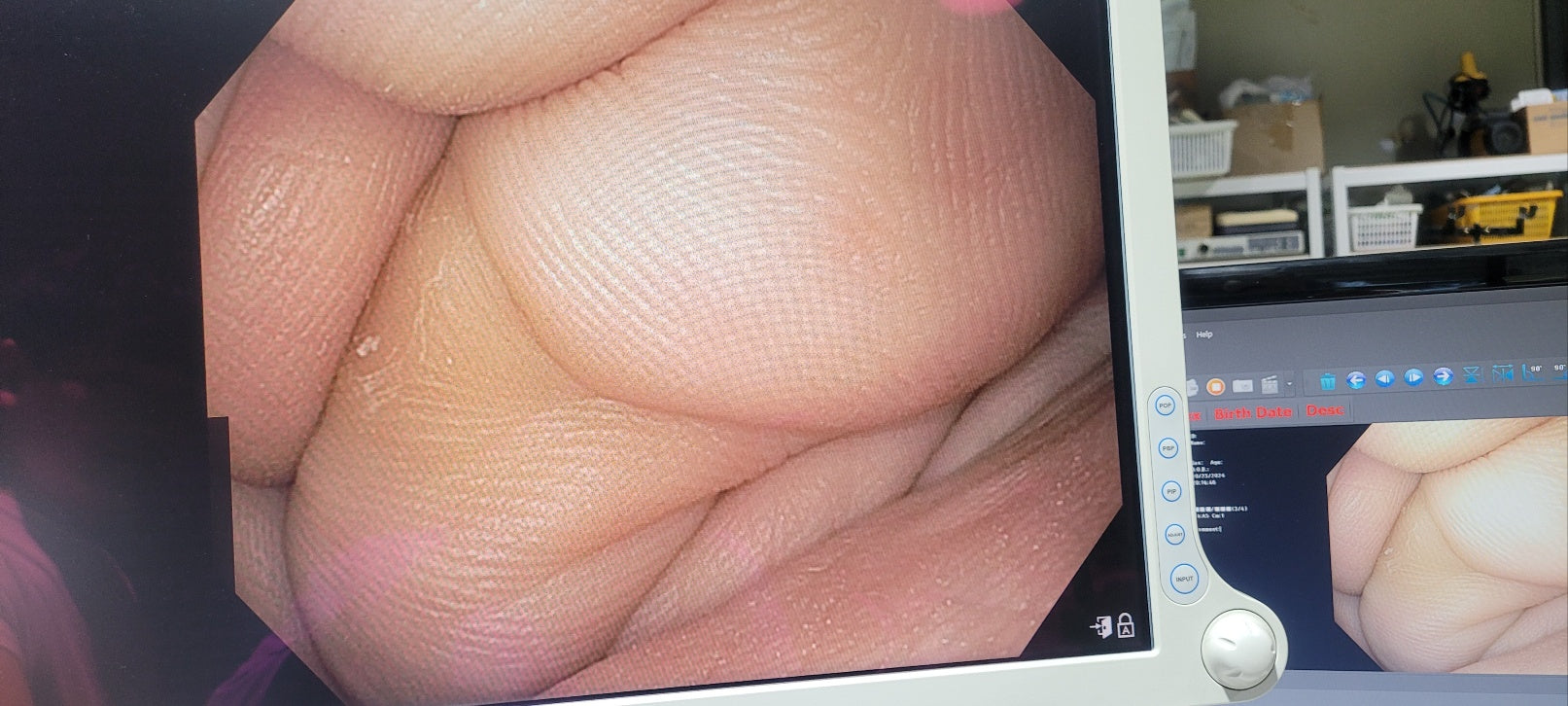 Used Olympus CV170 GIF H170 Gastroscope Full Endoscope System