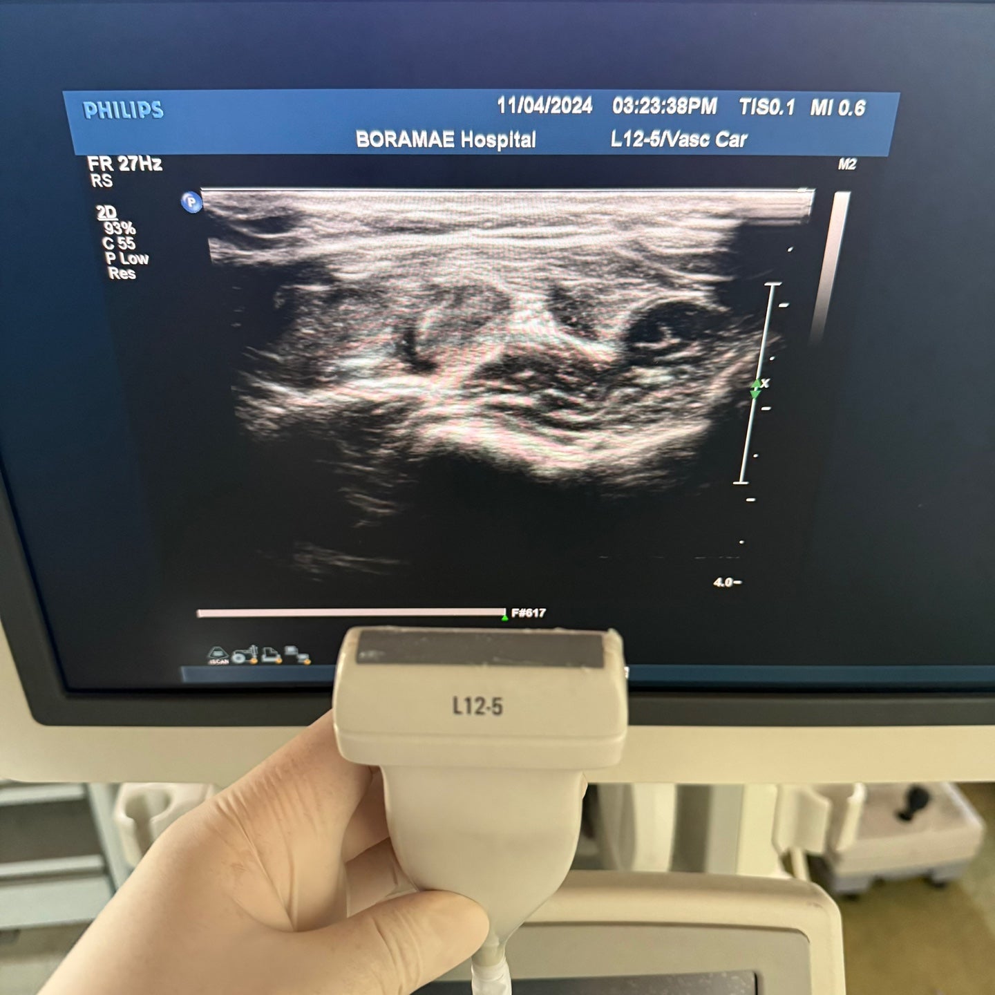 Philips IU22 with Convex & Linear 3 Probes