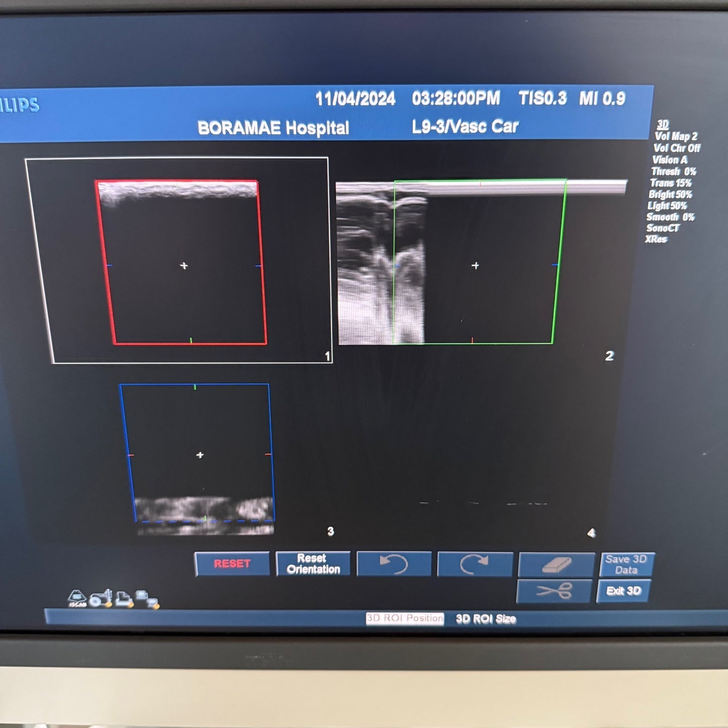 Philips IU22 with Convex & Linear 3 Probes