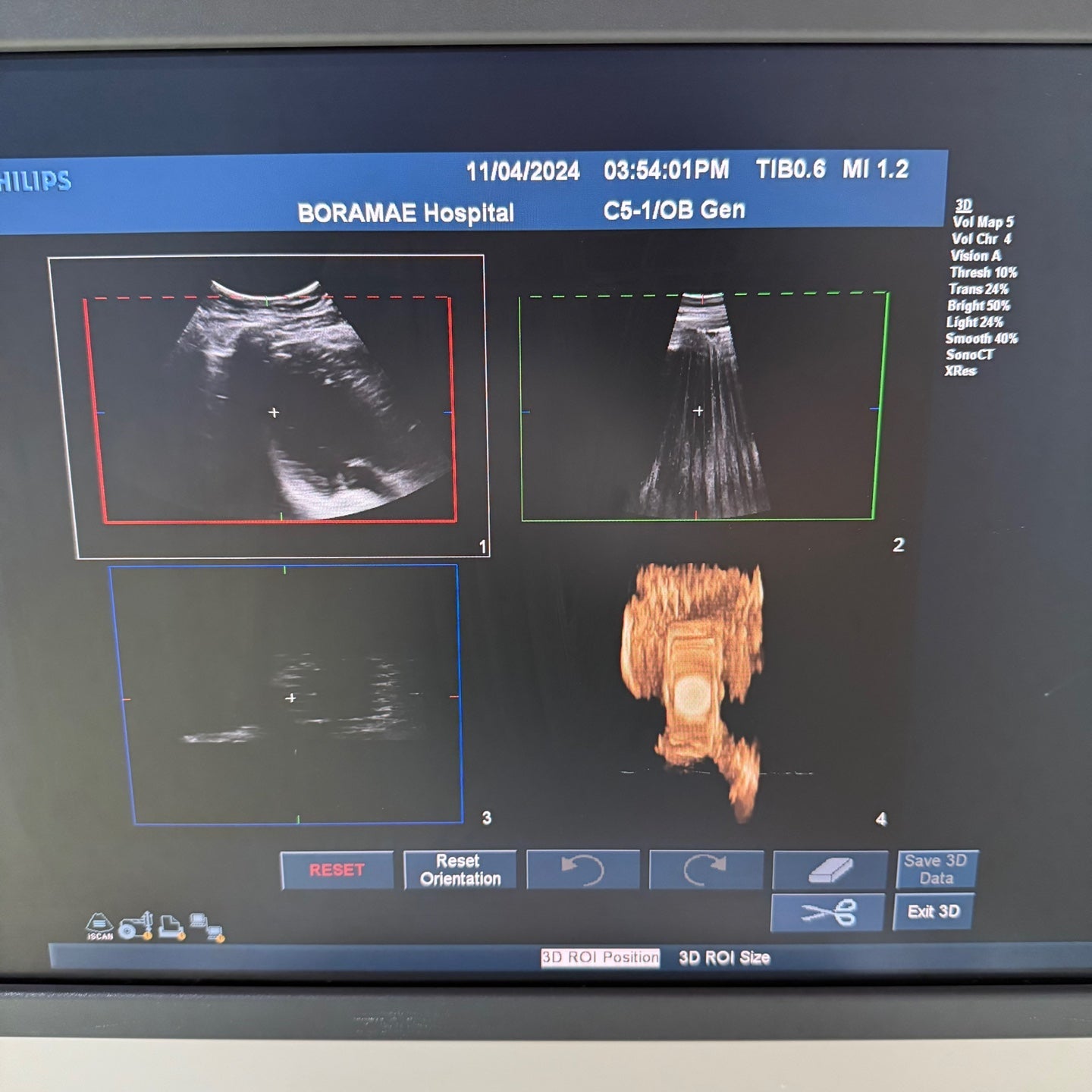 Philips IU22 with Convex & Linear 3 Probes