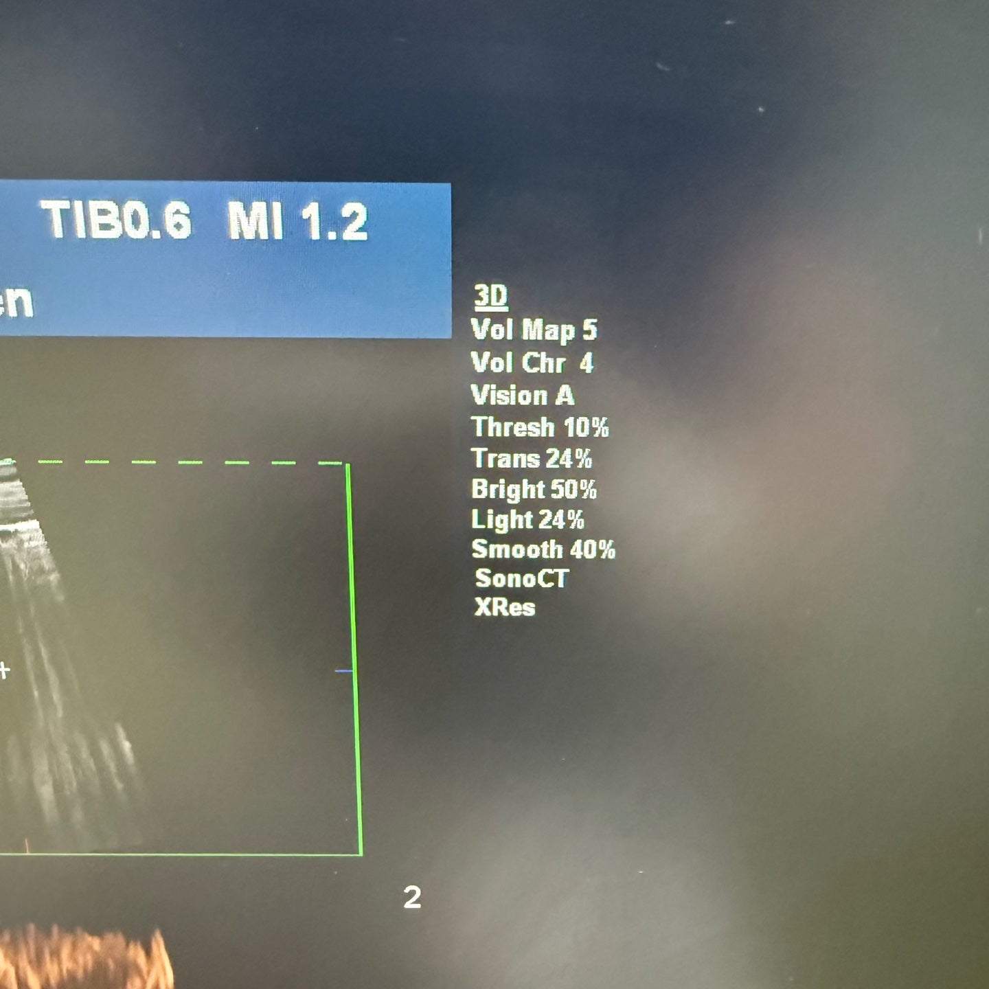 Philips IU22 with Convex & Linear 3 Probes