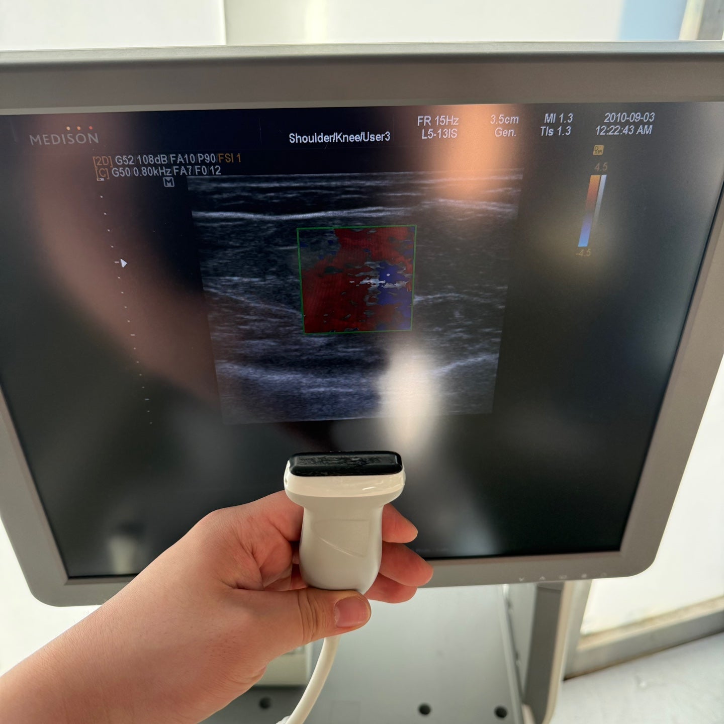 Samsung Medison accuvix XG with Convex, Linear & Vaginal 3 Probes