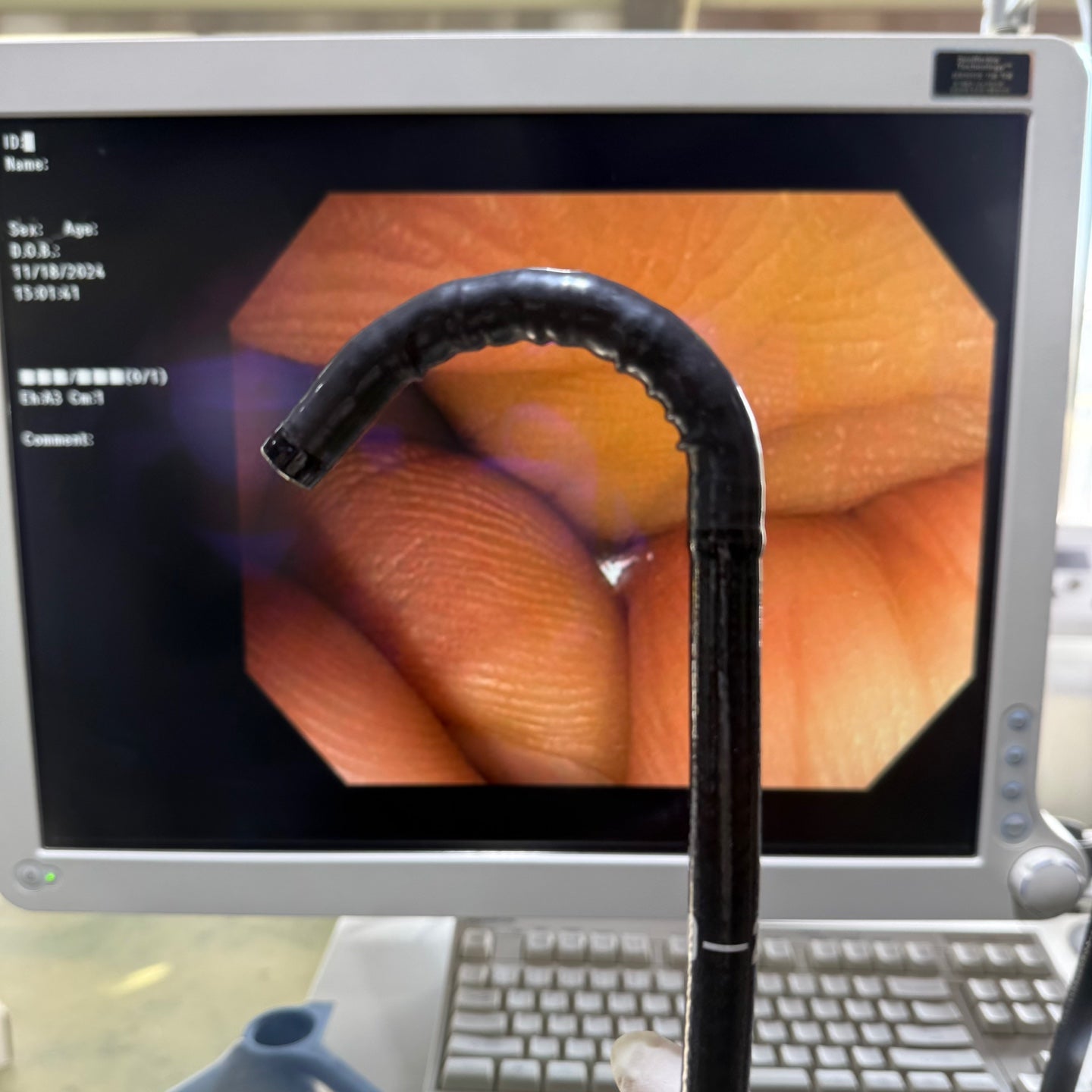 Used Olympus CF-H170L 12.8mm Colonoscope For Endoscopy