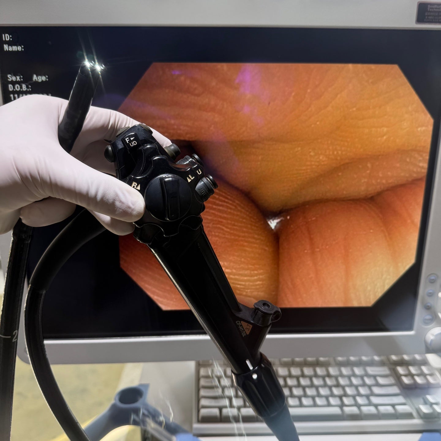 Olympus CV170 GIF H170 Gastroscope Full Endoscope System (2 Units)