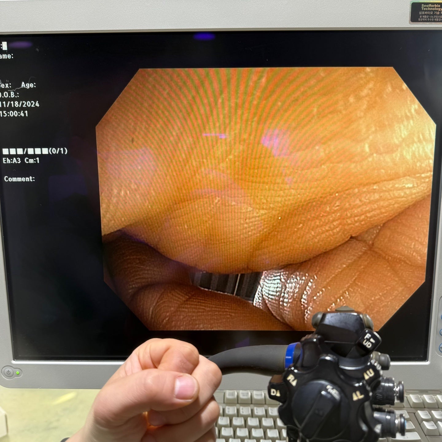 Olympus CV170 GIF H170 Gastroscope Full Endoscope System (2 Units)