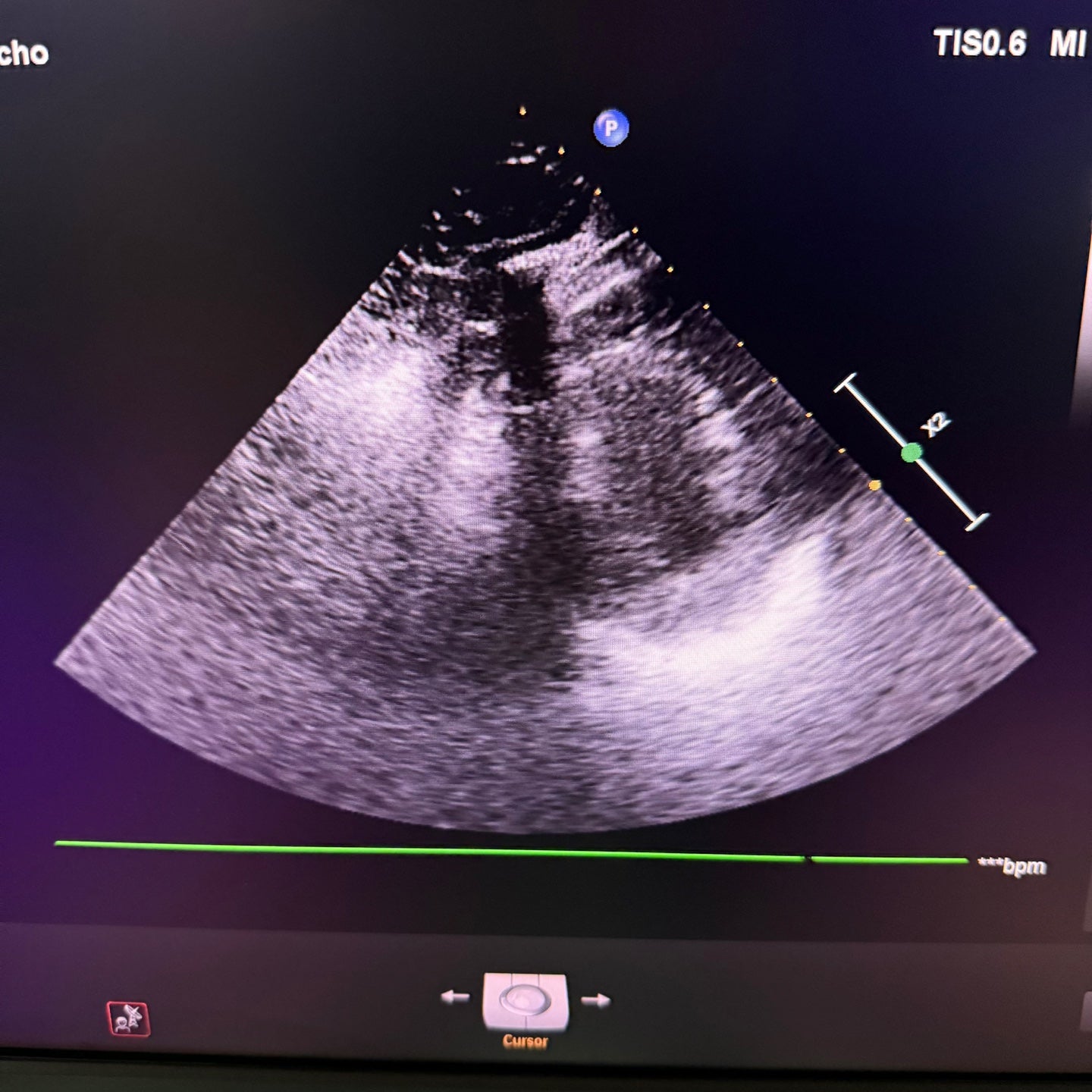 Philips Affiniti 50G with Cardiac, Convex & Linear 3 Probes