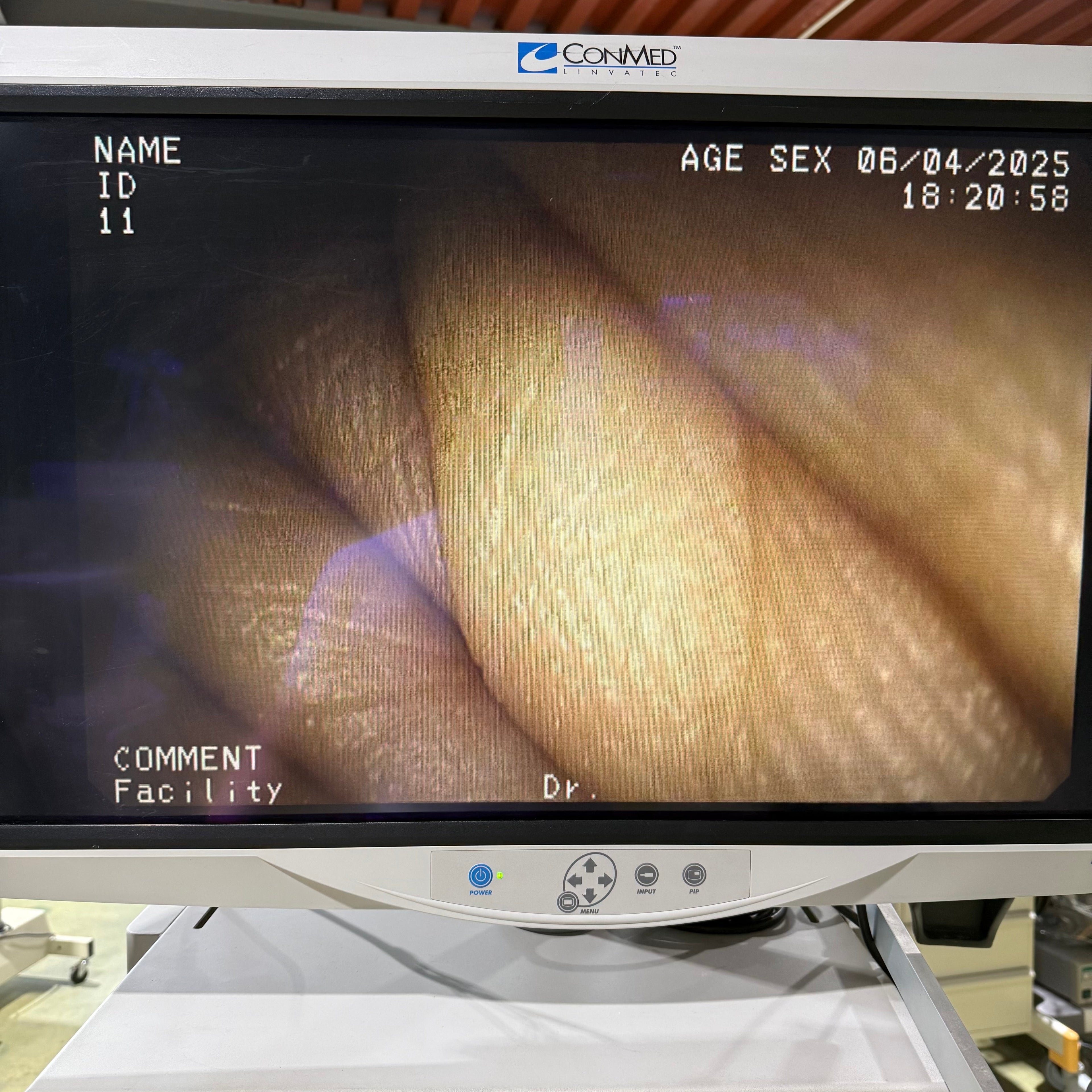 Pentax EPK-1000 with EG-2770K Gastroscope System
